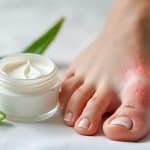 découvrez tout ce qu'il faut savoir sur la crème anti-inflammatoire pour hallux valgus : utilisation, bienfaits et conseils pour soulager efficacement la douleur.